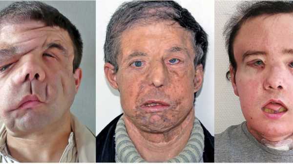 Man with 3 faces: Frenchman gets 2nd face transplant