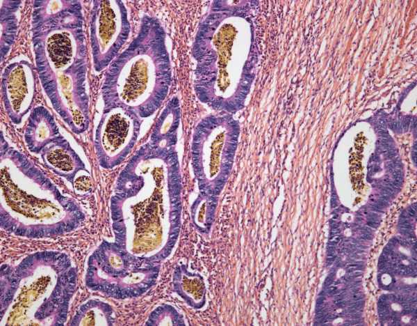 Colorectal cancer is killing more 20- to 30-year-olds. We now have one clue about why.
