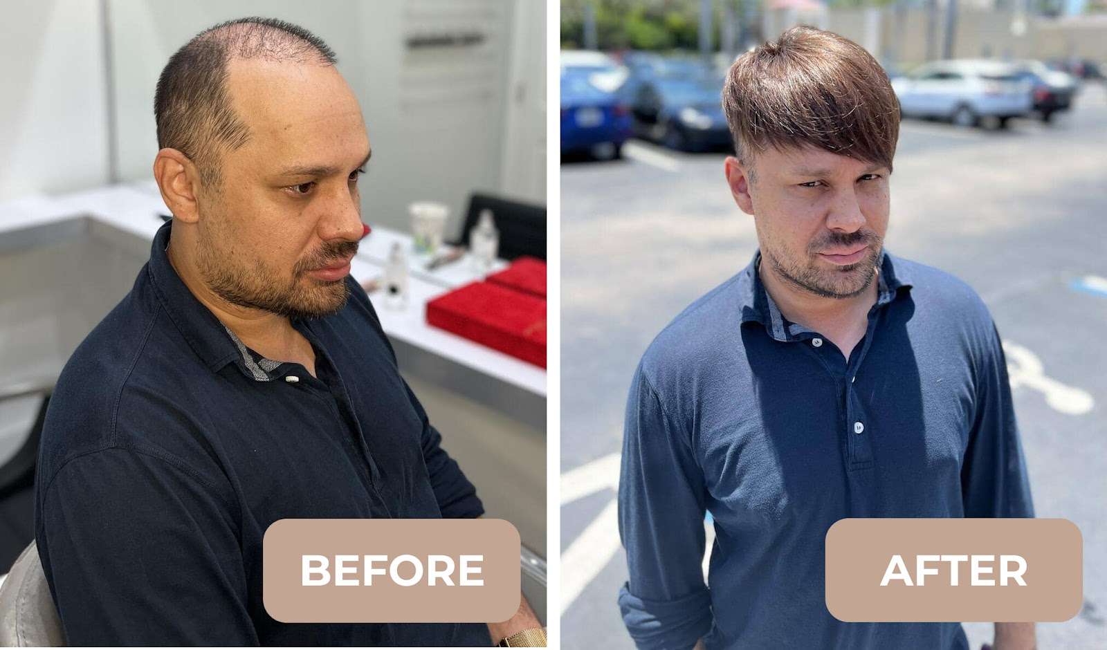 Hair replacement systems for men - a modern solution to alopecia