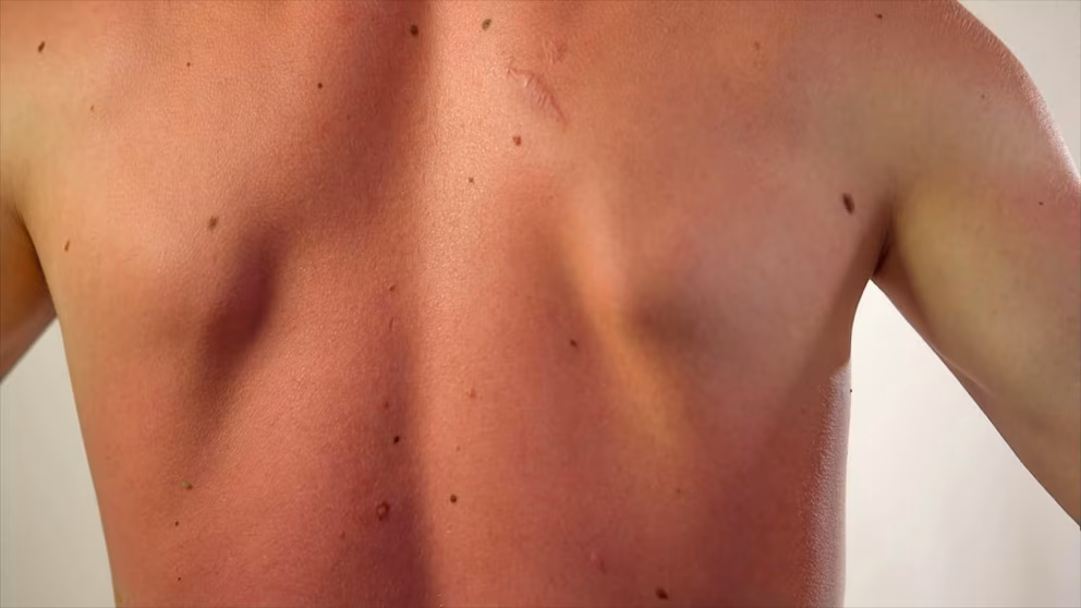 Video Men know they should wear sunscreen, so why aren’t they?