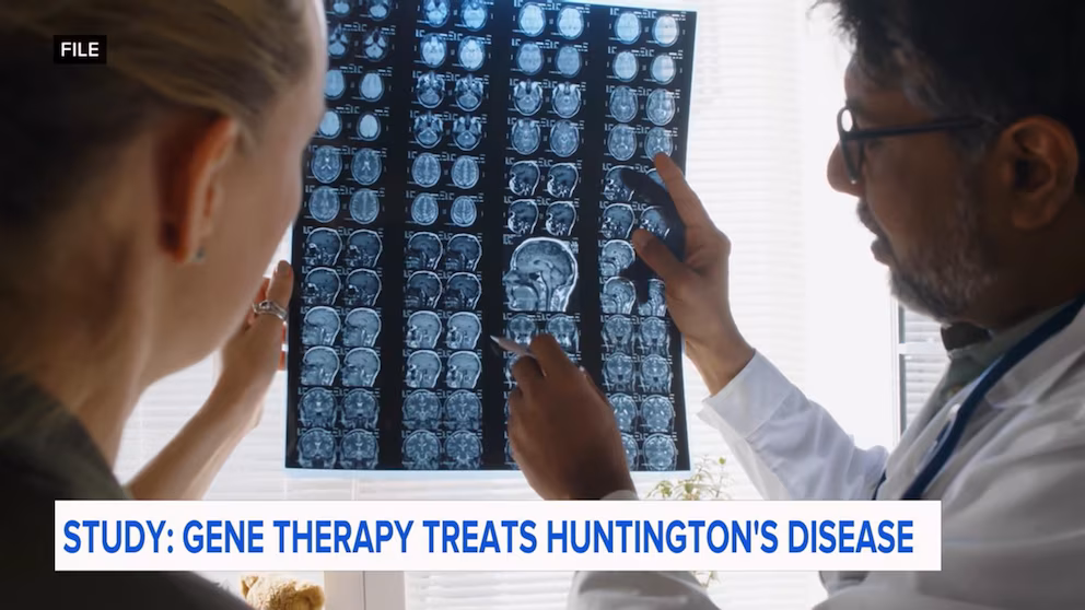 Initial gene treatment indicates a 75% slowing of Huntington’s ailment advance.