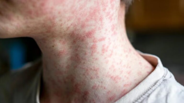 Measles Cases Quadruple in Weeks, Surpassing Typical Yearly US Count: CDC 13