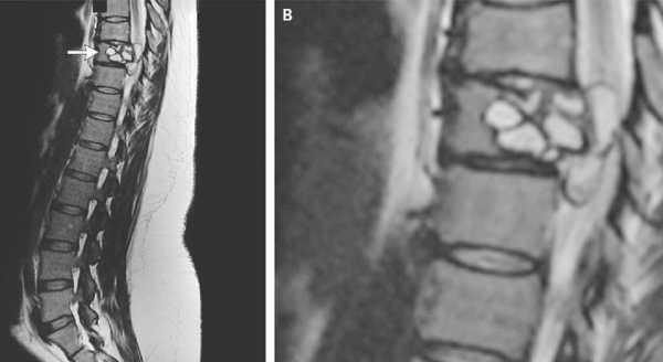 Tapeworm Larvae in Woman's Spine Sends 'Electric' Waves Through Legs - Report